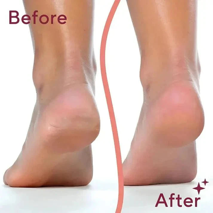 🦶 Electric Callus Remover by QuickTechQuickTechQuickTech🦶 Callus Remover by QuickTech QuickTech QuickTech